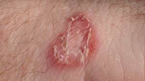 Does hand sanitizer kill viruses? Tinea Manuum Causes Symptoms And More
