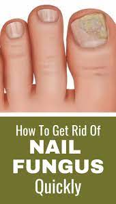 How To Get Rid Of Nail Fungus Quickly Nail Fungus Toenail Fungus Nail Fungus Treatment