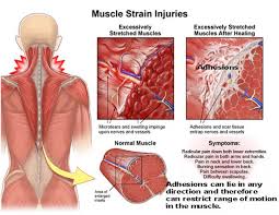 In these organs, muscles serve to move. Muscle Strains Back Pain From Shoveling Snow Balanced Body