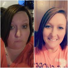 One year after gastric sleeve surgery for weight loss and cancer treatment