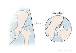 Image result for Hip Labral Tear