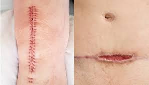 Image result for Wound