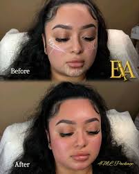 Facial balancing by me 💋 Arlington! Packages start at $600 Summer sale  price