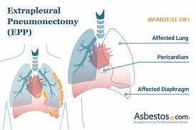 We did not find results for: Extrapleural Pneumonectomy Epp For Pleural Mesothelioma