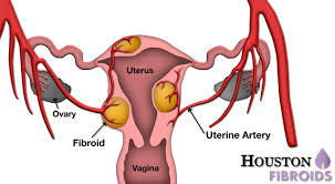 The location of the fibroid matters; Types Of Fibroids Tumors Houston Fibroids