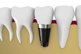 How Long Is The Dental Implant Healing Before The Crown Placement Advanced Dental New Windsor New York