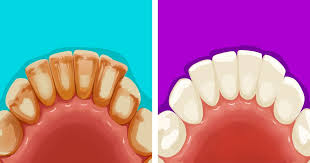 Gum detoxify deep clean, detoxify gentle whitening 6 Effective Ways To Remove Dental Plaque Naturally