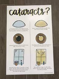 Cataract Poster Cataract Educational Poster Optometry Wall Etsy In 2021 Optometry Education Optometry Education Poster