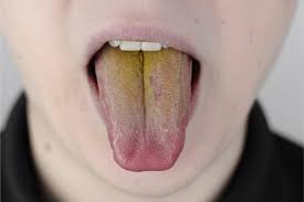 Image result for yellow tongue infection