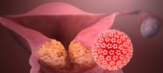 Virus Papillomy Cheloveka Vpch Simptomy Prichiny Lechenie