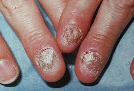 Image result for Akutní zánět nehtového lůžka