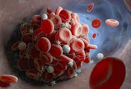 Only a few people have some symptoms when the blood pressure has reached the life. Blood Clot Symptoms Signs Causes Pictures