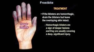 Image result for Frostbite