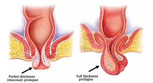 Image result for Rectal Prolapse