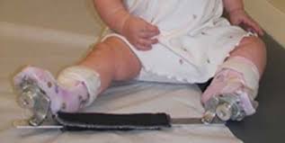 Symptoms of clubfoot in babies. Clubfoot Orthoinfo Aaos