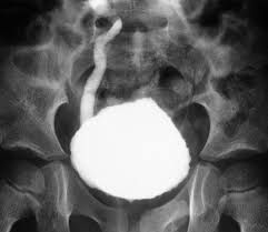 Image result for Voiding Cystourethrogram