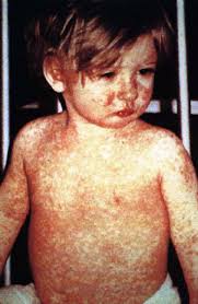 Image result for measles
