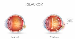 3 wie beeinflusst ad die okuläre. Glaukom Wichtige Augennahrstoffe