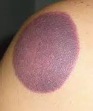 If any discolorations surface these are temporary, typically ranging in color from light pink to dark purple and can last anywhere between a few hours to 10 days before gradually fading away entirely. Frequently Asked Questions About Cupping Balance Acupuncture Massage