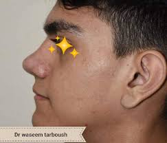 عملية تجميل انف rhinoplasty . الدكتور وسيم طربوش