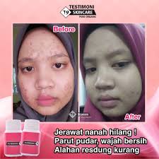 Cara yang saya nak cadangkan ini adalah gabungan kepada cara tradisional dan moden. Tips Hilangkan Jerawat T9 Skincare