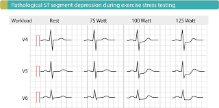 Evaluation Of Exercise Stress Test Ecg Symptoms Blood