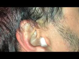 If your problem isn't serious, but you do feel like you have too much earwax buildup, you can gently clean the outside of your ears. Ear Wax Cleaning With Hydrogen Peroxide Youtube