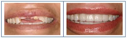 Maybe you would like to learn more about one of these? Cost Of Full Mouth Porcelain Veneers