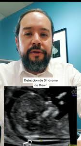 Síndrome de Down, Medicina Materno Fetal, ecografía del primer trimestre,  ecografía Genética. Dr. Eduardo Nava