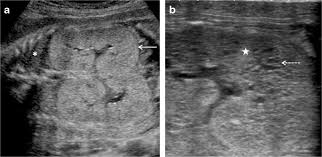 Prenatal Ultrasonography Of Autosomal Dominant Polycystic Kidney Disease Mimicking Recessive Type Case Series Springerlink