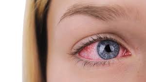 Rote Augen nach dem Schlafen - Ursachen, Tipps