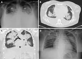 Fluid gathers in the lowest part of. Infective Bicuspid Aortic Valve Endocarditis Causing Acute Severe Regurgitation And Heart Failure A Case Report