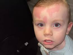 Toddler covered in 'red welts' minutes after mum gave him a bath with Asda  baby shampoo
