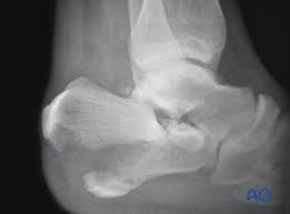 Image result for Calcaneus Compression Fracture