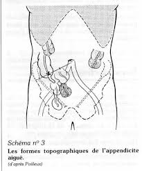 Péritonite aiguë, chronique, simple, tuberculeuse; Developpement Et Sante Appendicite Aigue
