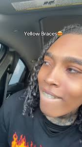 Discovering the Beauty of Yellow Braces