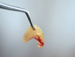 Această tehnologie reface un ţesut afectat de 7 ori mai repede decât vindecarea naturală. Perforation Der Schneider Schen Membran Zwp Online Das Nachrichtenportal Fur Die Dentalbranche
