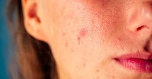 Because the birth control pill helps acne by changing the hormonal balance over time, it's probably best to withhold judgment about the effects until you've taken it for three or study after study shows that the vast majority of antibiotics, including minocycline, do not change how well birth control works. Do Accutane S Mental Health Effects Go Beyond Suicide The Atlantic