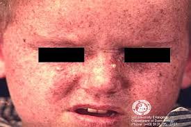 — a precancerous lesion is an acquired tissue change such as actinic. Xeroderma Pigmentosum