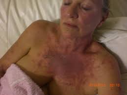 Take photo if you can, I would love to see your results. See Caroline Carters studies on www.thetruthdenied.com. Caroline Carter Morgellons Disease - 6-mar-2010-3