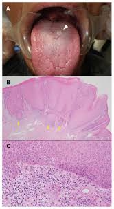 Image result for cancer of tongue