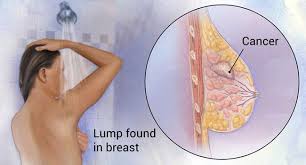 Local or regional treatments for stage iv breast cancer. Breast Cancer Awareness Latest Developments In Detection And What Is Making You Sick Education Today News