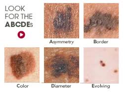 Since there are no general screening guidelines for skin cancer, most people need to rely on recognizing the signs and symptoms of the. Symptoms Midwest Dermatology Midwest Dermatology