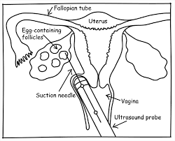 The Ivf Process Step By Step Timeline From Start To Finish