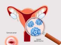 Image result for Cervical Cancer