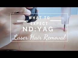 Laser hair removal is a convenient, noninvasive method for permanently reducing or removing unwanted facial or body hair. Nd Yag Laser Hair Removal Experiance Q A Brown Dark Skin What To Expect How Does It Work Truth Youtube