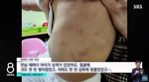 Tubuh si kecil ini sekali lagi didera bapanya apabila ibu meminta bapa kejam itu menjaga bayi berkenaan. Usus Pecah Dan Badan Penuh Lebam Kisah Menyayat Hati Bayi 16 Bulan Jeong In Maut Didakwa Didera Ibu Bapa Angkat