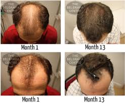 Chronic stress has also long been linked to hair loss, but the reasons weren't well understood. Male Hair Loss All You Need To Know