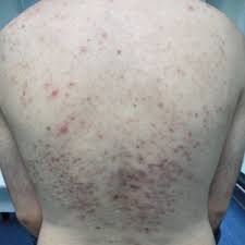 Image result for Pathergy