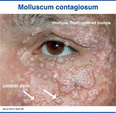 Image result for skin rash acute hiv infection